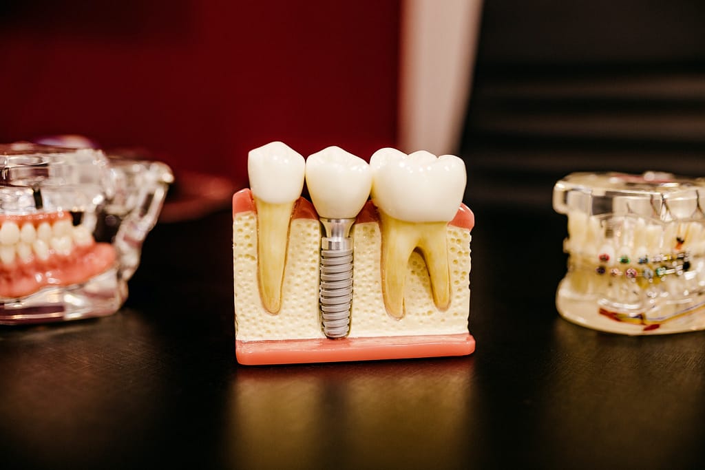 Modèle en pâte d'implants dentaires et de dents classiques