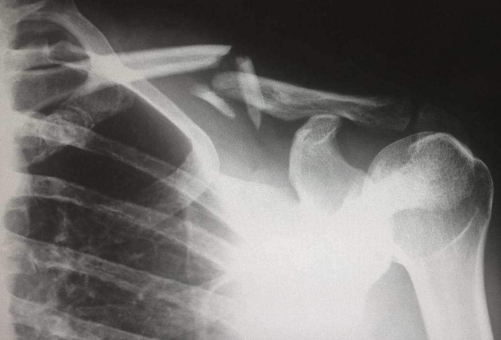 radiographie faite à l'hôpital d'une épaule cassée