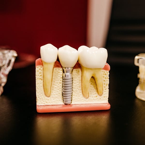 Modèle en pâte d'implants dentaires et de dents classiques